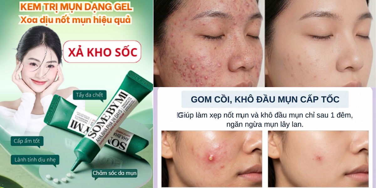 Đưa hình ảnh phân tích hiệu quả trước và sau khi dùng kem trị mụn